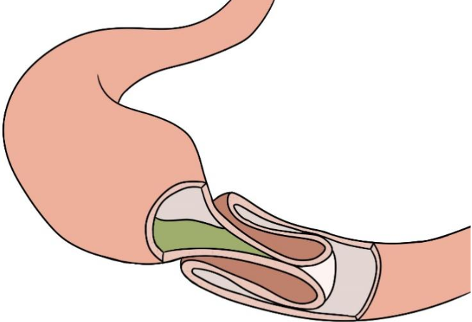 儿童肠套叠：不容忽视的肠道“叠叠乐”