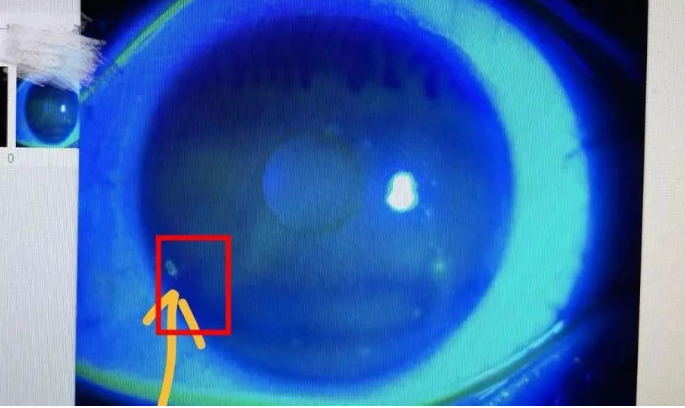 角膜损伤，螨虫蠕动，甚至秃了……爆火的它暗藏“陷阱”！ 第 1 张