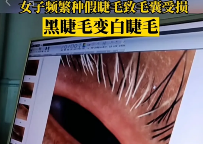 角膜损伤，螨虫蠕动，甚至秃了……爆火的它暗藏“陷阱”！ 第 4 张