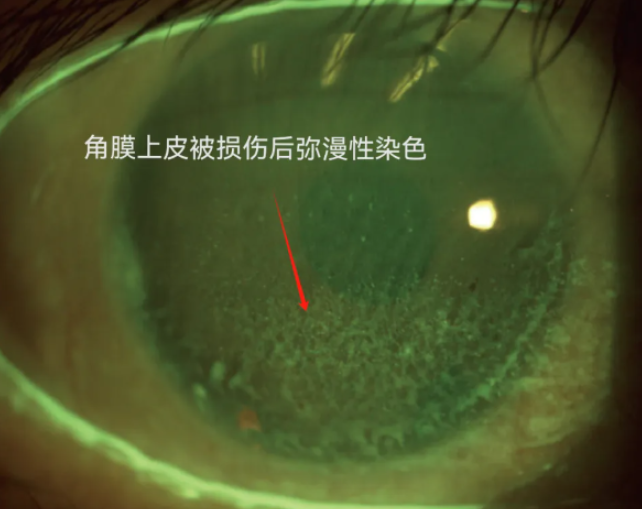 角膜损伤，螨虫蠕动，甚至秃了……爆火的它暗藏“陷阱”！ 第 3 张