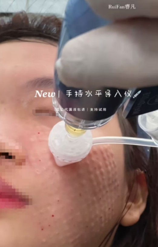 “居家水光”：是院线平替，还是毁肤陷阱？ 第 5 张